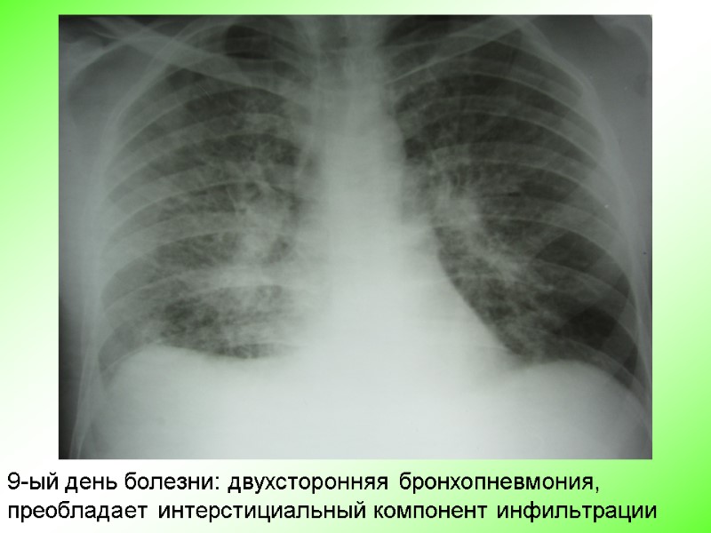 9-ый день болезни: двухсторонняя бронхопневмония,  преобладает интерстициальный компонент инфильтрации